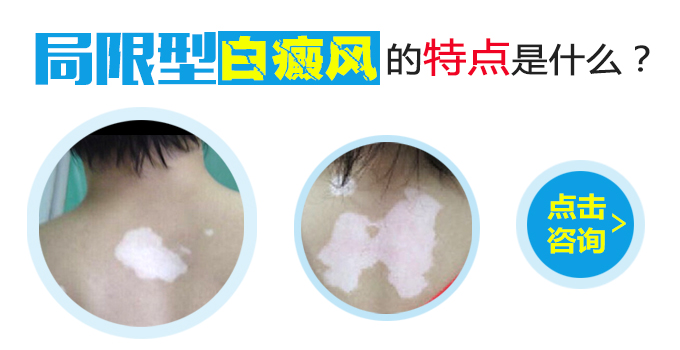 局限型白癜风的特点是什么？(图1)