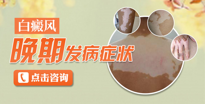 白癜风发病晚期症状有什么(图1)