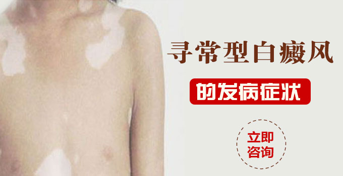 寻常型白癜风的发病症状有那些？(图1)
